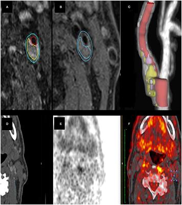 Association Between 18-FDG Positron Emission Tomography and MRI Biomarkers of Plaque Vulnerability in Patients With Symptomatic Carotid Stenosis